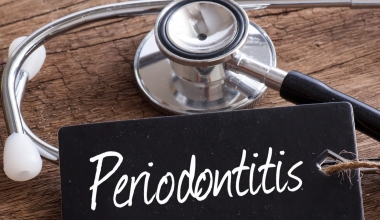 Parodontitis Parodontitis