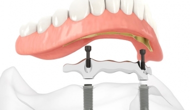 Stegprothese Stegprothese